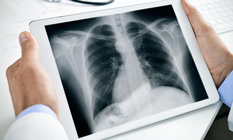 X-ray digital radiography (DR)